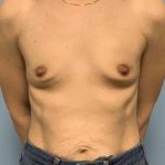 Breast Augmentation Before & After Patient #12056