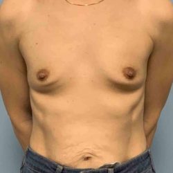 Breast Augmentation Before & After Patient #12056