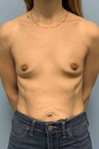Breast Augmentation Before & After Patient #12056