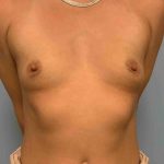 Breast Augmentation Before & After Patient #12063