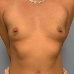 Breast Augmentation Before & After Patient #12063
