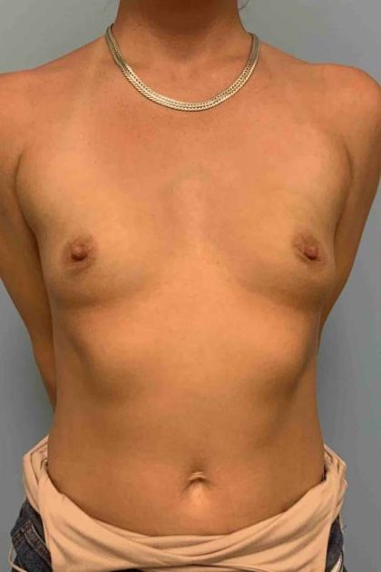 Breast Augmentation Before & After Patient #12063