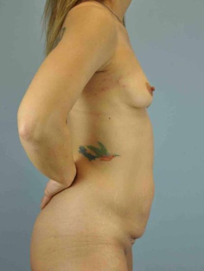 Breast Augmentation Before & After Patient #12070