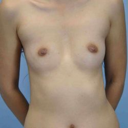 Breast Augmentation Before & After Patient #12077