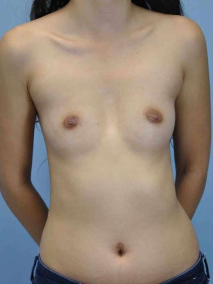 Breast Augmentation Before & After Patient #12077