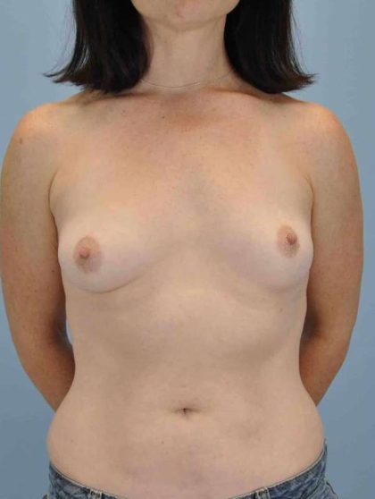 Breast Augmentation Before & After Patient #12089