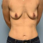 Breast Augmentation Before & After Patient #12108