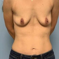 Breast Augmentation Before & After Patient #12108