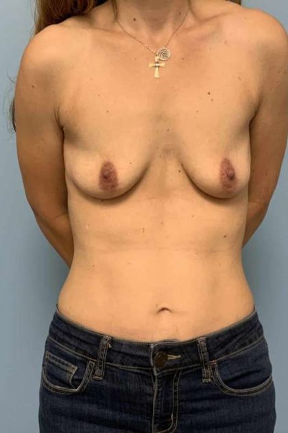 Breast Augmentation Before & After Patient #12108