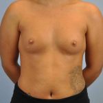 Breast Augmentation Before & After Patient #12120