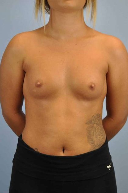 Breast Augmentation Before & After Patient #12120