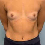 Breast Augmentation Before & After Patient #12127