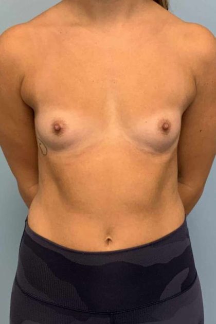 Breast Augmentation Before & After Patient #12127