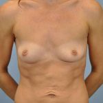 Breast Augmentation Before & After Patient #12143