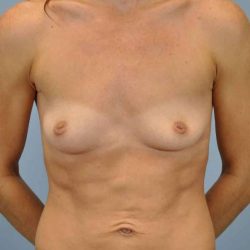 Breast Augmentation Before & After Patient #12143