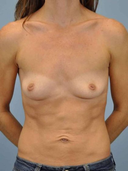 Breast Augmentation Before & After Patient #12143