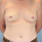 Breast Augmentation Before & After Patient #12150