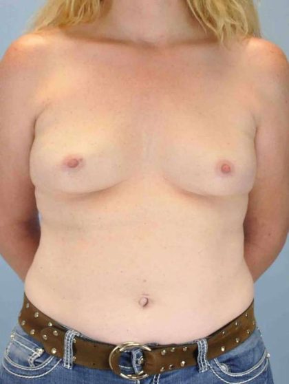 Breast Augmentation Before & After Patient #12150