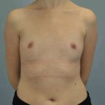 Breast Augmentation Before & After Patient #12157