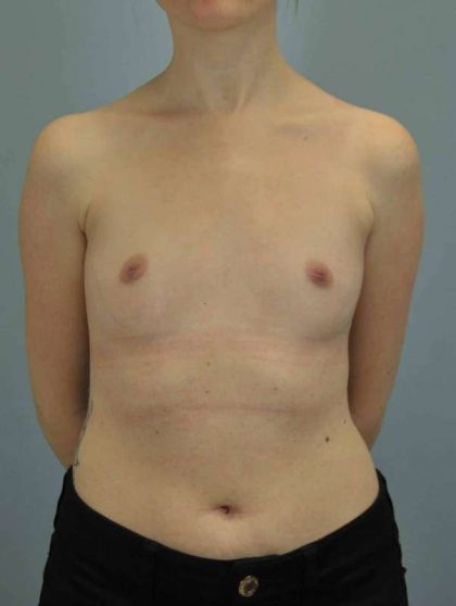 Breast Augmentation Before & After Patient #12157