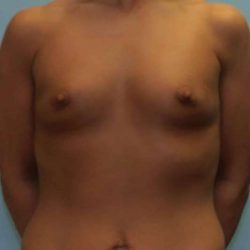 Breast Augmentation Before & After Patient #12164