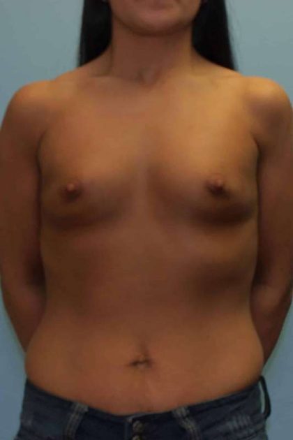 Breast Augmentation Before & After Patient #12164