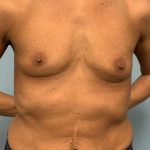 Breast Augmentation Before & After Patient #12171
