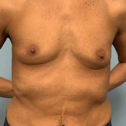 Breast Augmentation Before & After Patient #12171