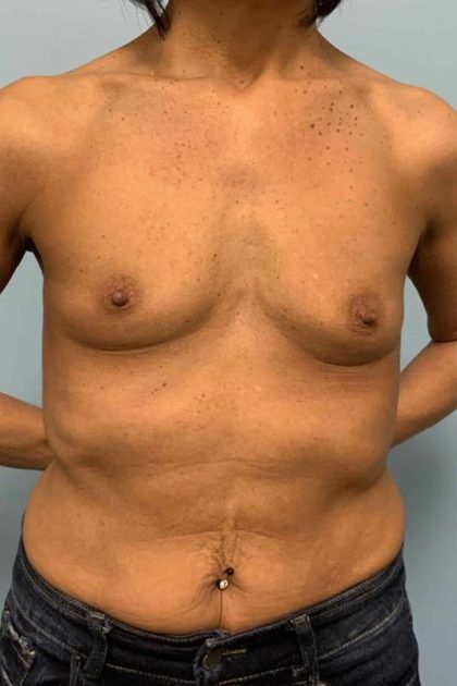 Breast Augmentation Before & After Patient #12171