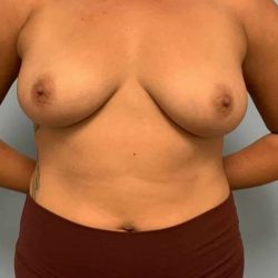 Breast Augmentation Before & After Patient #12178