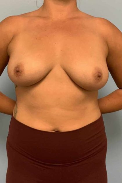 Breast Augmentation Before & After Patient #12178