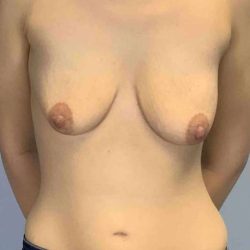 Breast Augmentation Before & After Patient #12185