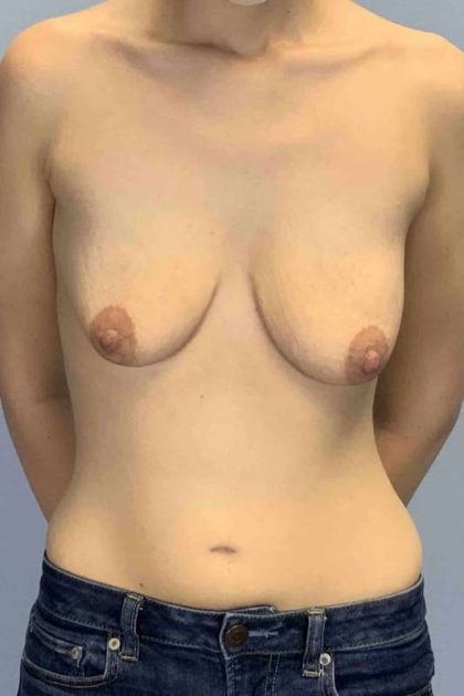 Breast Augmentation Before & After Patient #12185