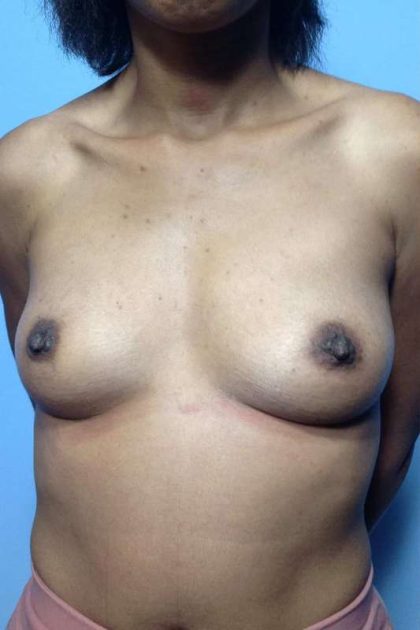 Breast Augmentation Before & After Patient #12199
