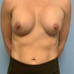 Breast Augmentation Before & After Patient #12206