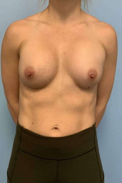 Breast Augmentation Before & After Patient #12206