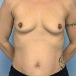 Breast Augmentation Before & After Patient #12220