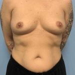 Breast Augmentation Before & After Patient #12227