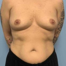 Breast Augmentation Before & After Patient #12227