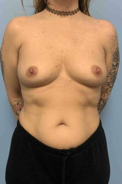 Breast Augmentation Before & After Patient #12227