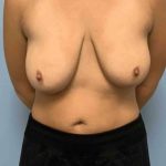 Breast Augmentation Before & After Patient #12234