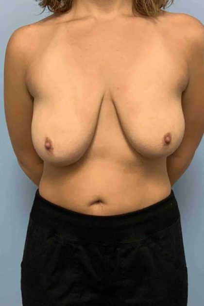 Breast Augmentation Before & After Patient #12234