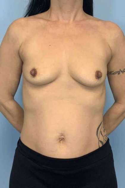 Breast Augmentation Before & After Patient #12246