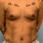 Breast Augmentation Before & After Patient #12253