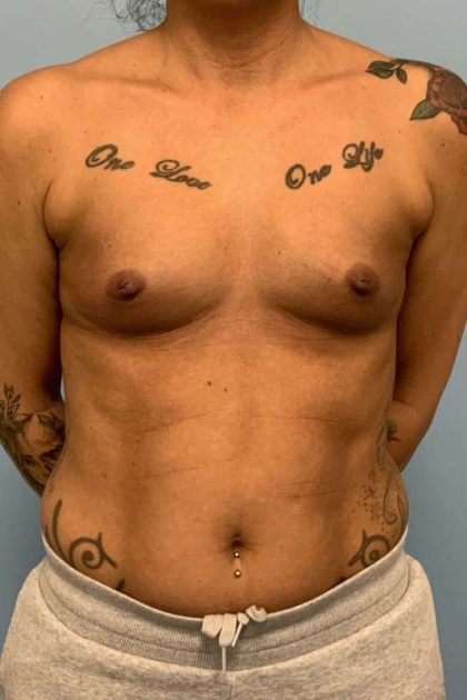 Breast Augmentation Before & After Patient #12253