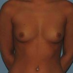 Breast Augmentation Before & After Patient #12260