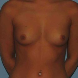 Breast Augmentation Before & After Patient #12260