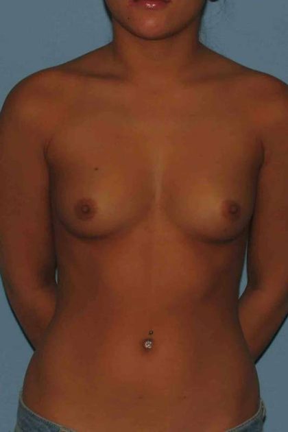 Breast Augmentation Before & After Patient #12260