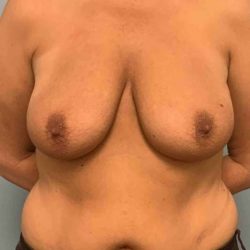 Breast Augmentation Before & After Patient #12274