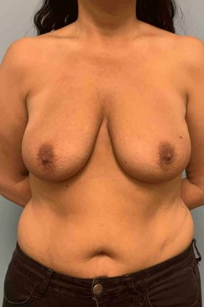 Breast Augmentation Before & After Patient #12274